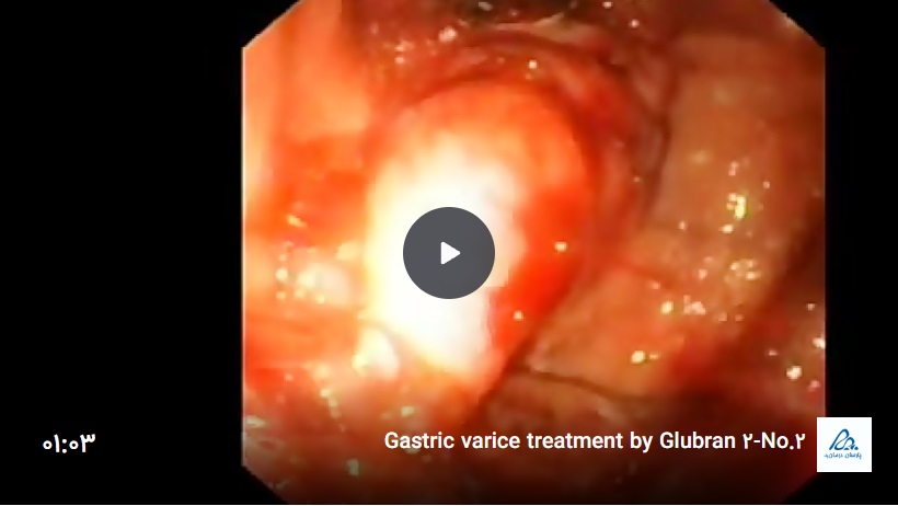 فیلم درمان واریس معده با چسب جراحی گلوبرن 2