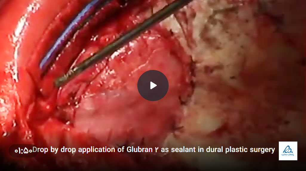 فیلم جراحی پلاستیک دورال با عایق چسب گلوبرن2