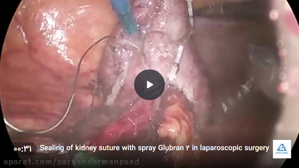 فیلم جراحی لاپاراسکوپی آب بندی بخیه کلیه با گلوبرن2