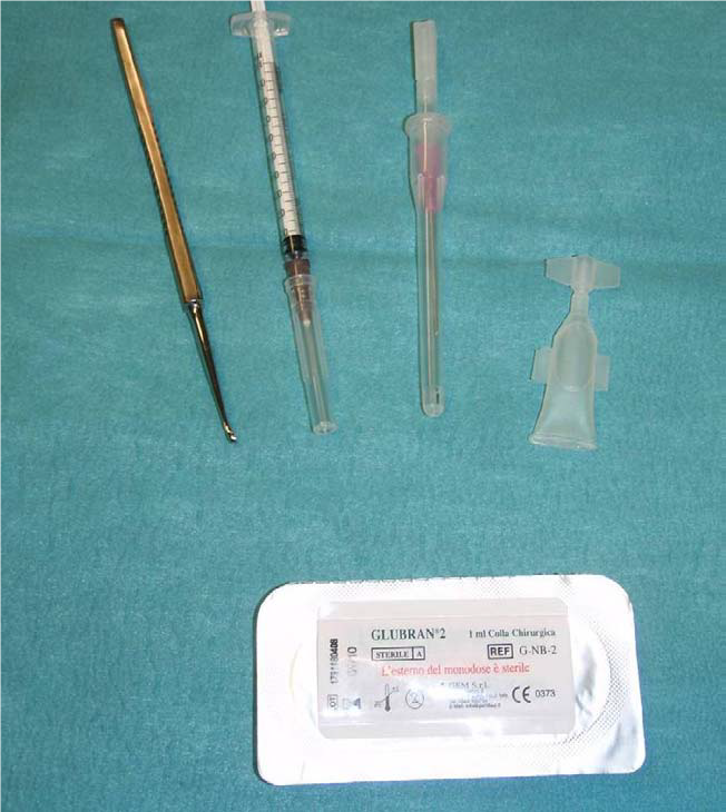 اثربخشی درمان با چسب فیستول سینتتیک سیانو اکریلات جراحی گلوبرن2 در درمان فیستول کریپتوگلندولار بالا در آنو