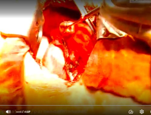 استفاده از چسب سیانواکریلات جراحی گلوبرن 2 با استفاده از اسپری مخصوص به عنوان هموستاتیک و سیلانت در جراحی رزکسیون ریوی